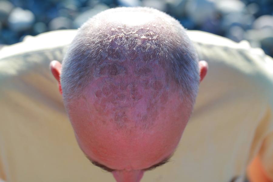 How To Get Rid Of Dry Skin On Bald Head