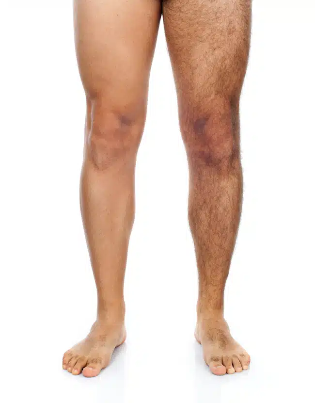 man with left leg shaved and right leg hairy