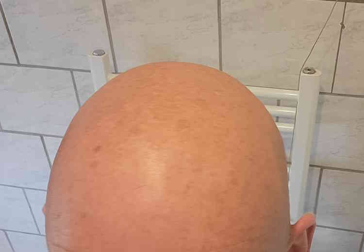 bald head after applying Formula 10.0.6 Seriously Shine Free Mattifying Moisturizer