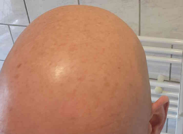 bald head after using Men Expert Hydra Energetic Anti-Shine Moisturizer
