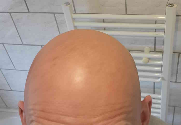 bald head before applying Formula 10.0.6 Seriously Shine Free Mattifying Moisturizer