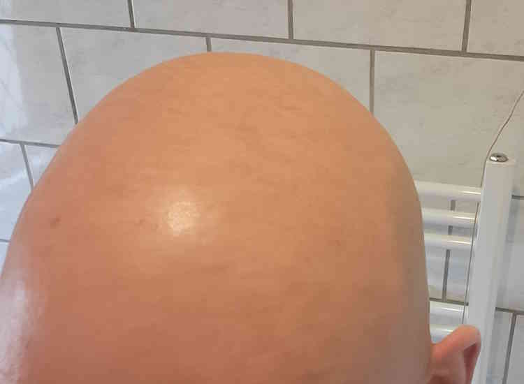 bald head before using Men Expert Hydra Energetic Anti-Shine Moisturizer