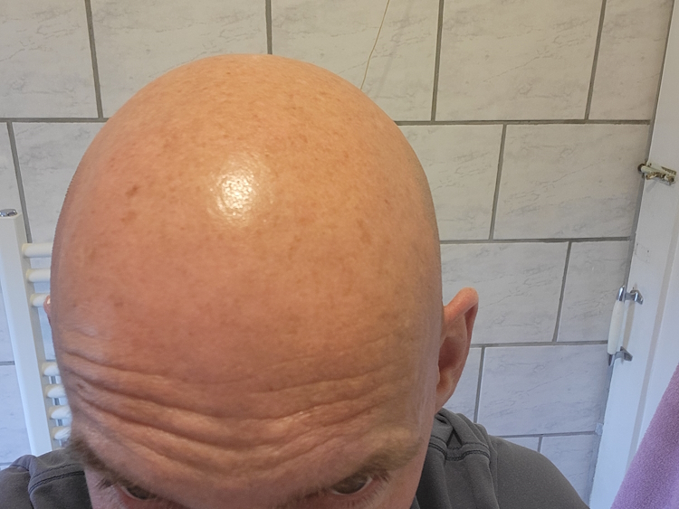 bald head before applying Bald Boss Face & Scalp Moisturiser