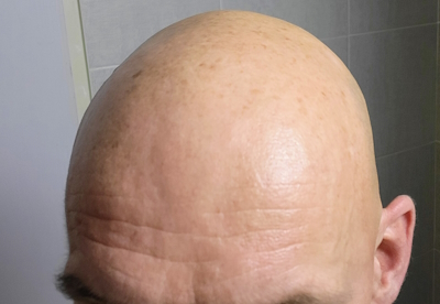 Jason Jones bald head after applying BLD BRO Daily